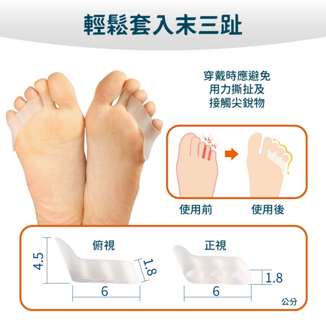 小趾內翻分趾器